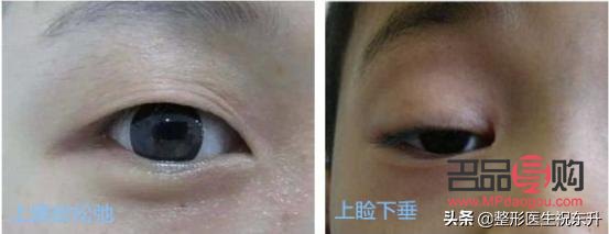 眼皮松弛下垂手术前后对比照片(眼皮松弛下垂手术多长时间恢复)