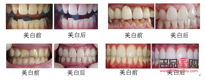 <h3>美容院整牙齿吗？专业解答与注意事项</h3>