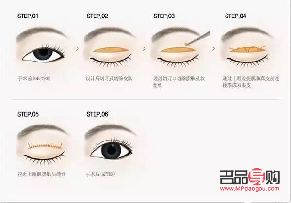 眼睑提肌无力怎么治疗