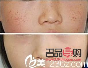 祛斑美容要多少钱(祛斑美容要多少钱)