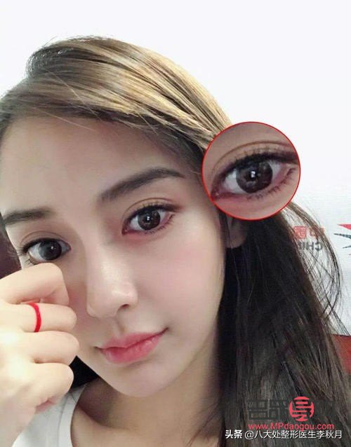 <h3>双眼皮增生图片解析与应对方法</h3>