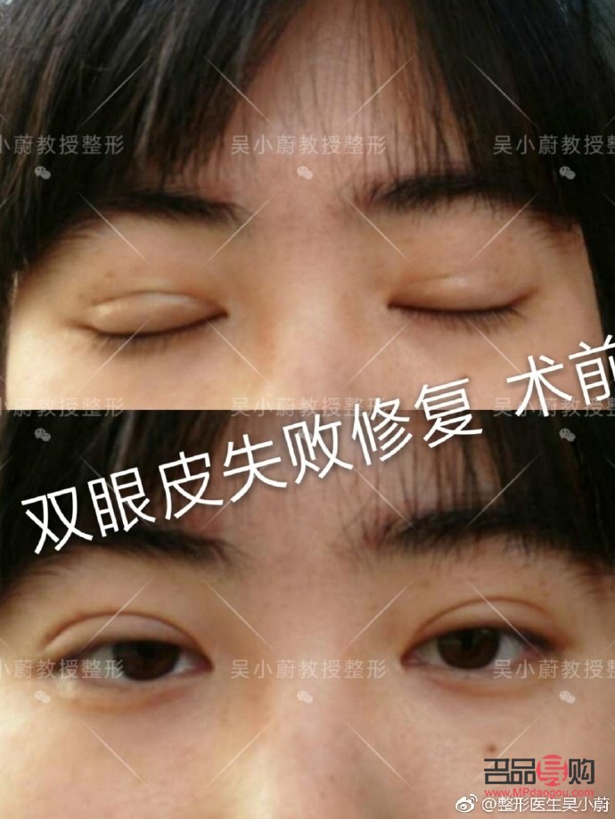 <h3>双眼皮增生图片解析与应对方法</h3>