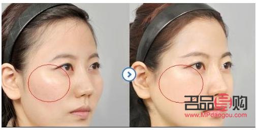 颧骨外扩也美容吗(颧骨外扩一定很丑吗)