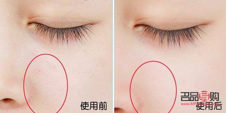 <h3>眼睛下面皱纹怎么去除最有效果</h3>