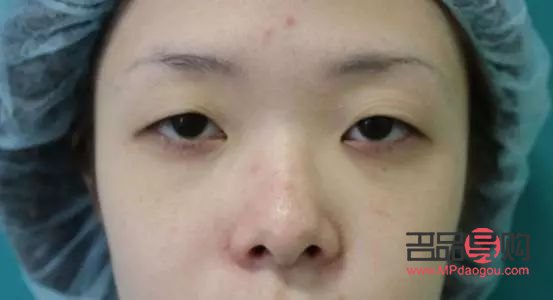 单眼皮眼皮下垂怎么办(单眼皮眼皮下垂了怎么让它提上去)