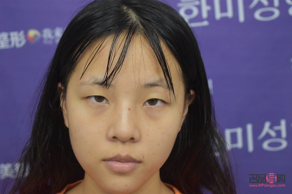 单眼皮眼皮下垂怎么办(单眼皮眼皮下垂了怎么让它提上去)