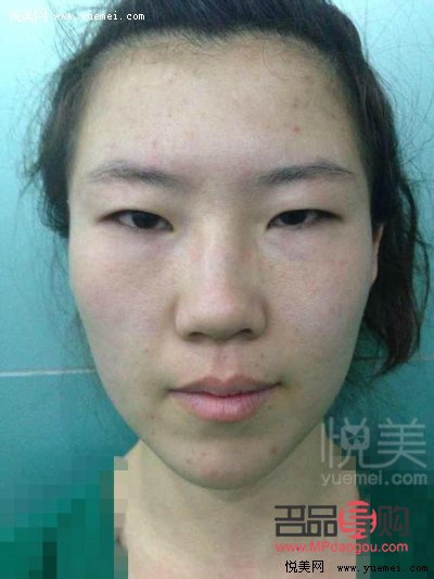 单眼皮眼皮下垂怎么办(单眼皮眼皮下垂了怎么让它提上去)