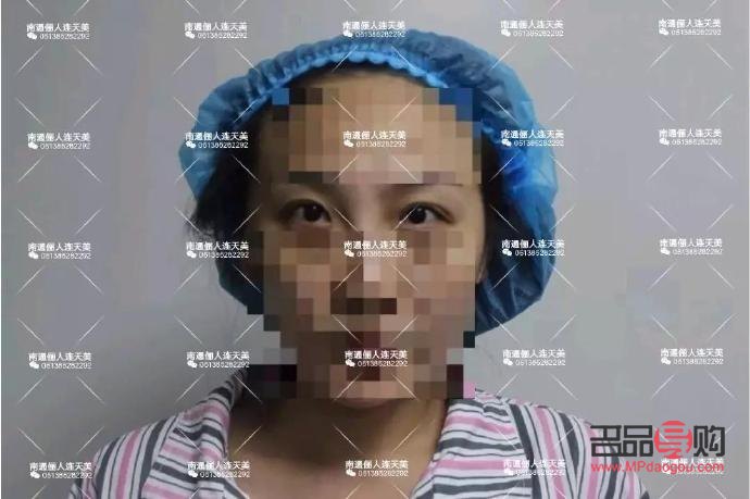 割双眼皮是全切好还是埋线好(割双眼皮是全切好还是埋线好一点) 割双眼皮是全切好还是埋线好(割双眼皮是全切好还是埋线好一点)