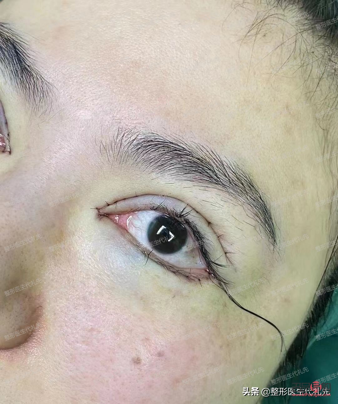 割双眼皮是全切好还是埋线好(割双眼皮是全切好还是埋线好一点)