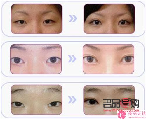 如何让内双眼皮变外双眼皮呢