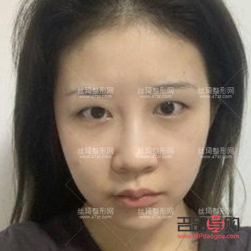 <h3>全切双眼皮手术：塑造明亮双眼的优选方案</h3>