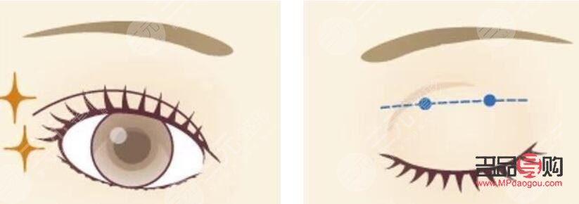 <h3>全切双眼皮手术：塑造明亮双眼的优选方案</h3>