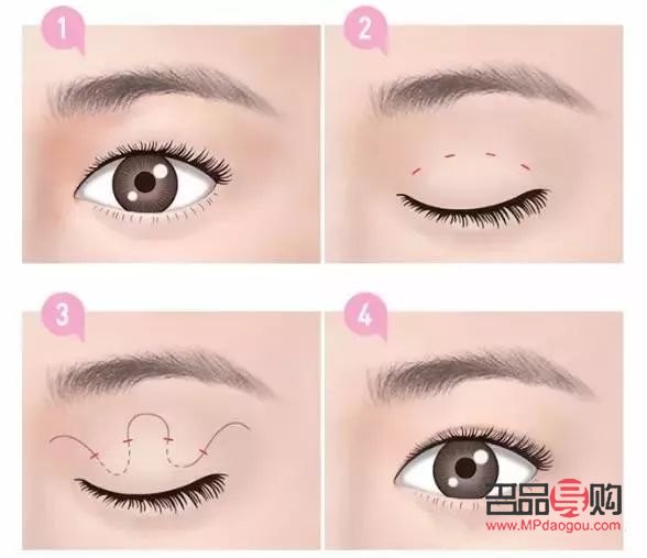 <h3>一单一双可以做双眼皮手术吗?</h3> <h3>一单一双可以做双眼皮手术吗?</h3>