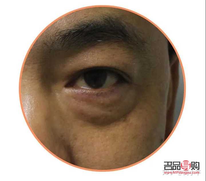 <h3>15岁有眼袋怎么办才能消除</h3>