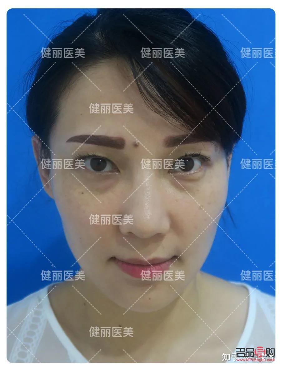 15岁有眼袋怎么办才能消除