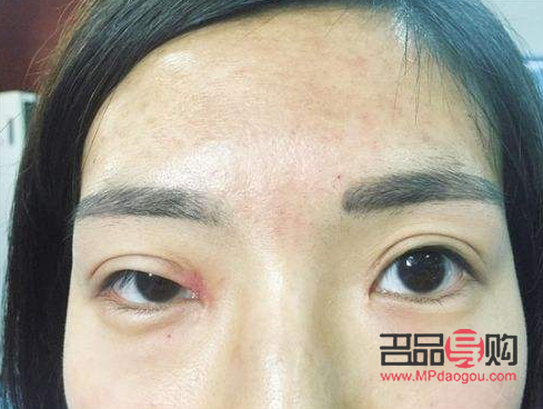 甲状腺手术后眼睛一大一小怎么办(甲状腺手术后眼睛一大一小怎么办呀)