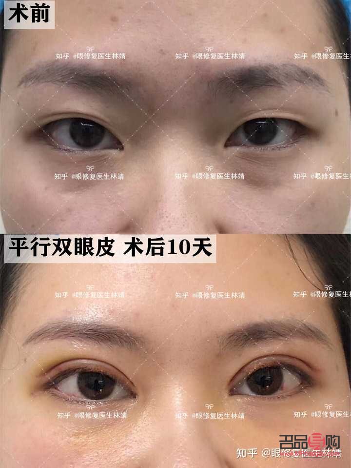 甲状腺手术后眼睛一大一小怎么办(甲状腺手术后眼睛一大一小怎么办呀)