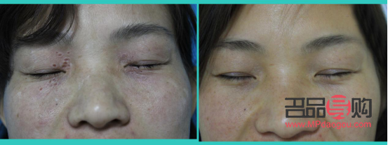 汗管瘤眼部激光多少钱？全面解析激光治疗汗管瘤的费用问题