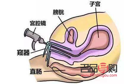 刮宫后如何护理身体