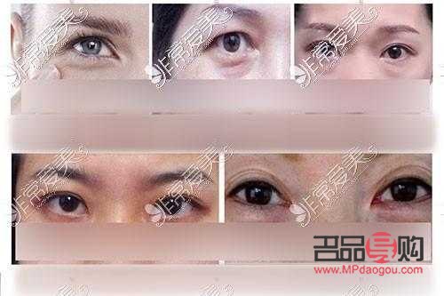 眼角提拉手术的费用大概是多少钱？全面解析手术价格因素