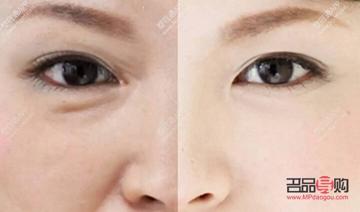 <h3>怎样淡化泪沟和眼袋</h3> <h3>怎样淡化泪沟和眼袋</h3>