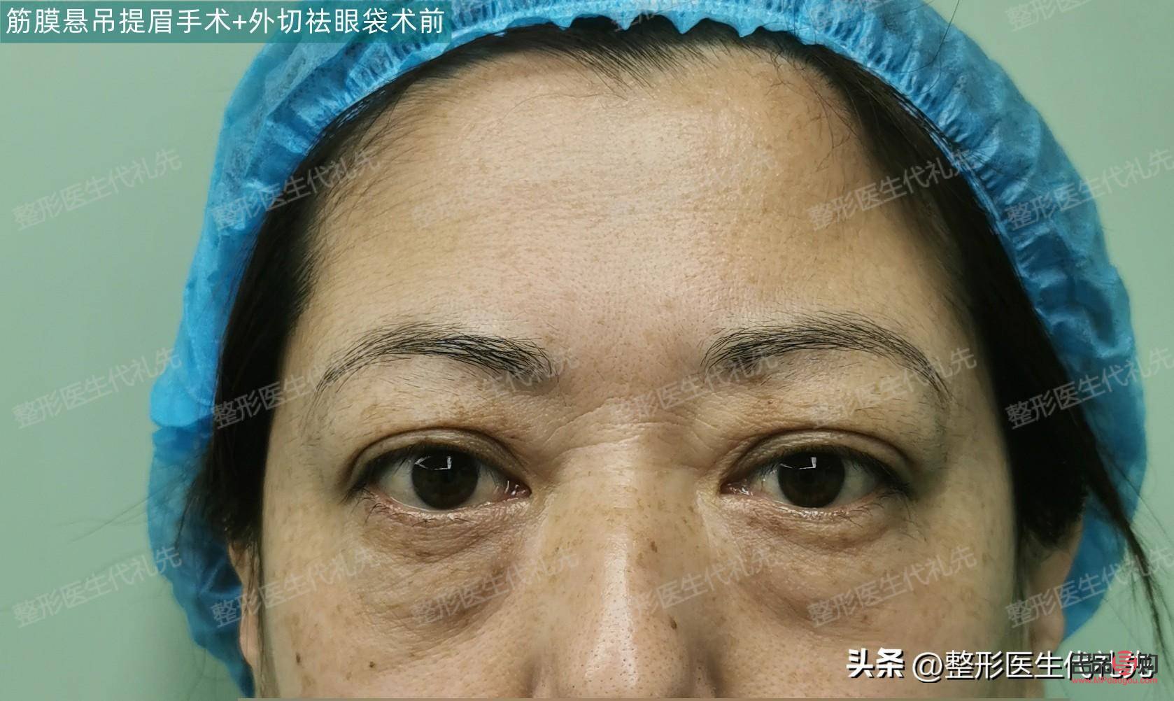 眼袋修复专家排名(眼袋修复专家排名)