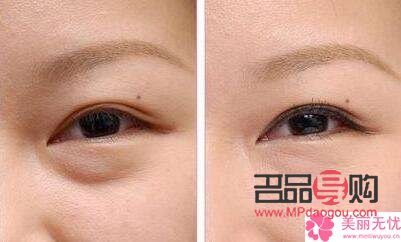 眼袋修复专家排名(眼袋修复专家排名)