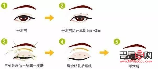 <h3>割双眼皮1万6是否贵？全面解析双眼皮手术价格与价值</h3>