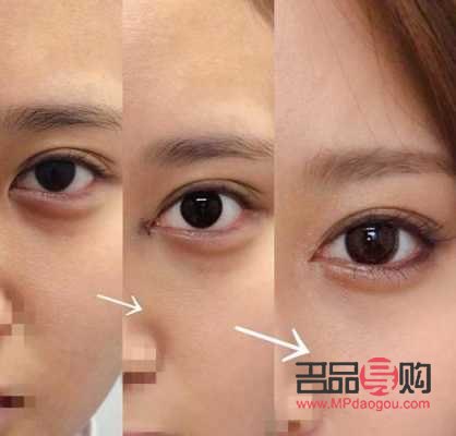 <h3>眼部综合整形价格是多少？全面解析眼部整形费用及影响因素</h3>