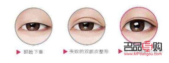 <h3>眼部综合整形价格是多少？全面解析眼部整形费用及影响因素</h3>