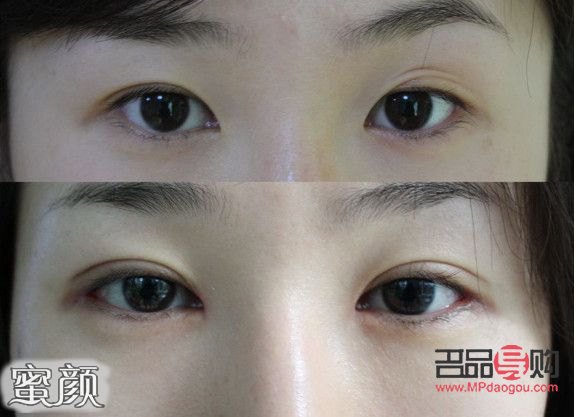微创双眼皮10天恢复图(微创双眼皮10天恢复图片大全)
