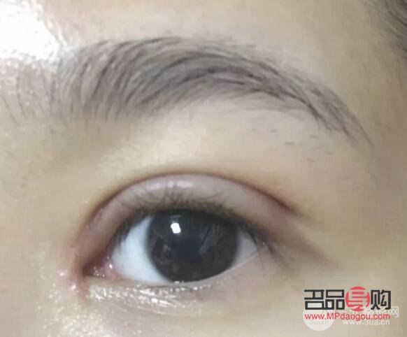 微创双眼皮10天恢复图(微创双眼皮10天恢复图片大全)