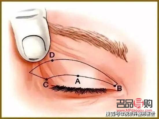 提拉眼皮需要多少钱一次(提拉眼皮需要多少钱一次手术)