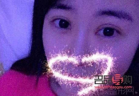 割双眼皮图片恢复图记录：美丽蜕变的详细日志