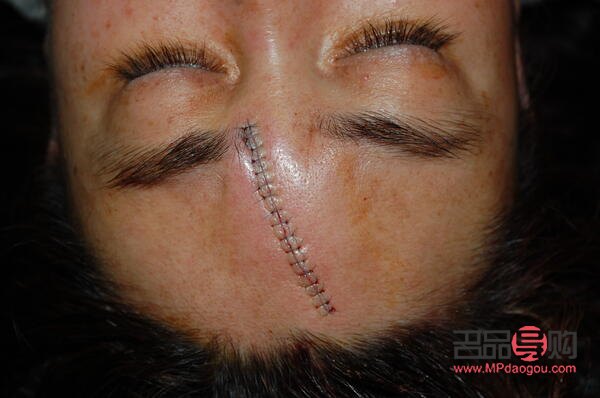 <h3>美容缝线如何拆除</h3>