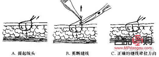 <h3>美容缝线如何拆除</h3>