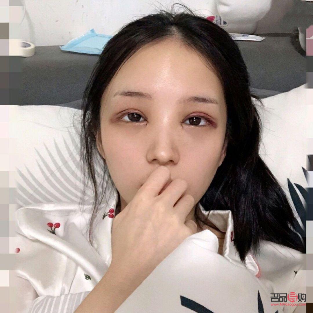 40岁后慎割双眼皮(40岁后慎割双眼皮一年自然)