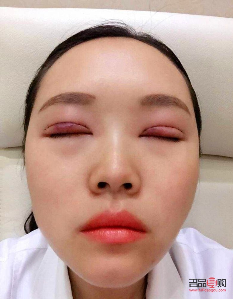 40岁后慎割双眼皮(40岁后慎割双眼皮一年自然)