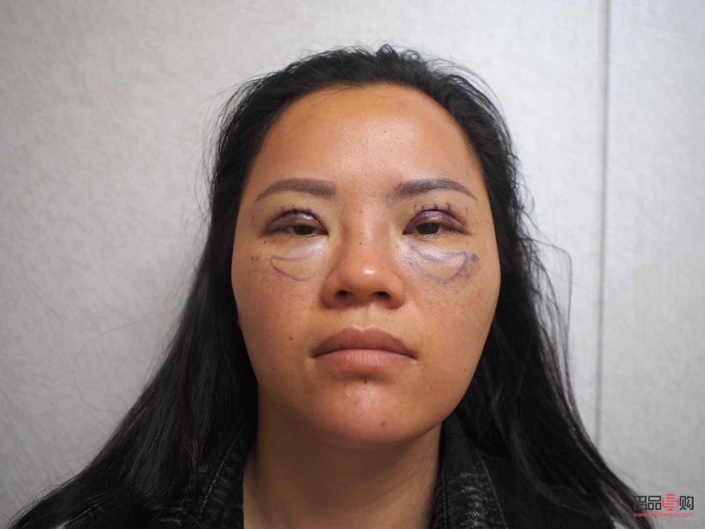 40岁后慎割双眼皮(40岁后慎割双眼皮一年自然)