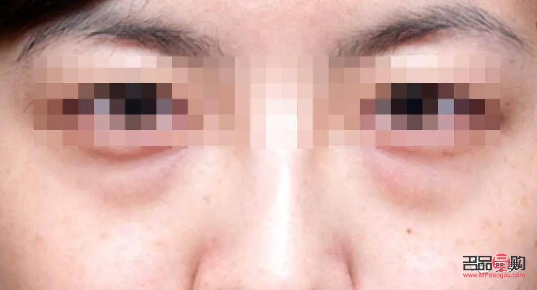 眼下八字泪沟怎么消除(眼下八字泪沟怎么消除图片)