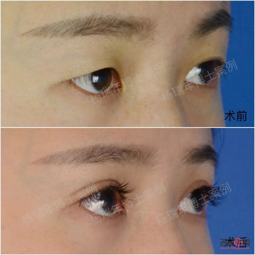 一单一双眼皮怎么改善不割(一单一双眼皮怎么矫正除了手术)