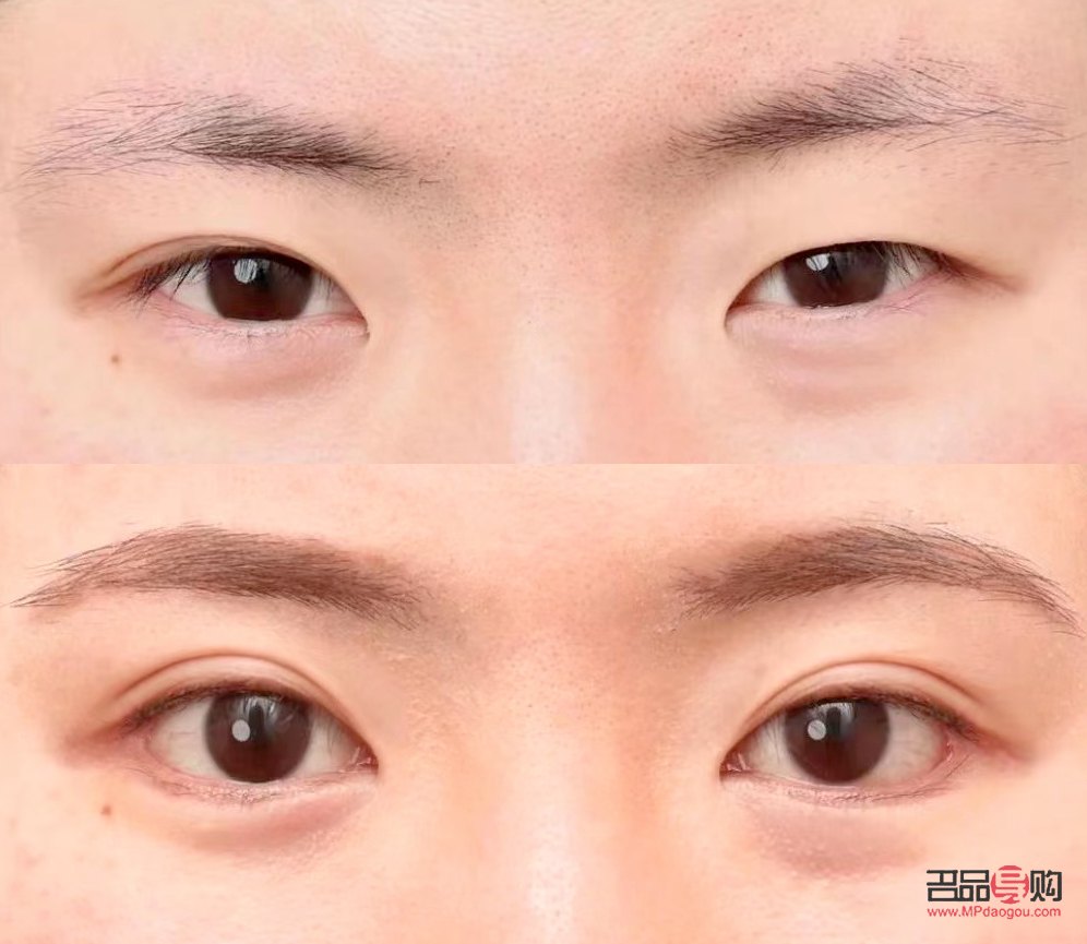 一单一双眼皮怎么改善不割(一单一双眼皮怎么矫正除了手术)