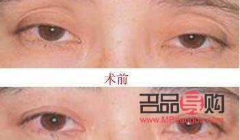 眼皮下垂怎么自然恢复吃什么好(眼皮下垂怎么做会改善)