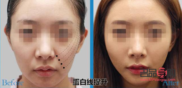 <h3>线雕美容安全吗</h3>