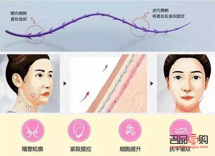 线雕美容安全吗