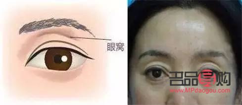 <h3>眼窝凹陷脂肪填充能维持多久</h3>