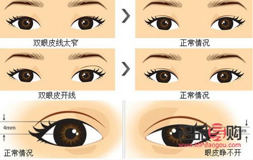 新月形的双眼皮图片大全(新月形的双眼皮图片大全大图)