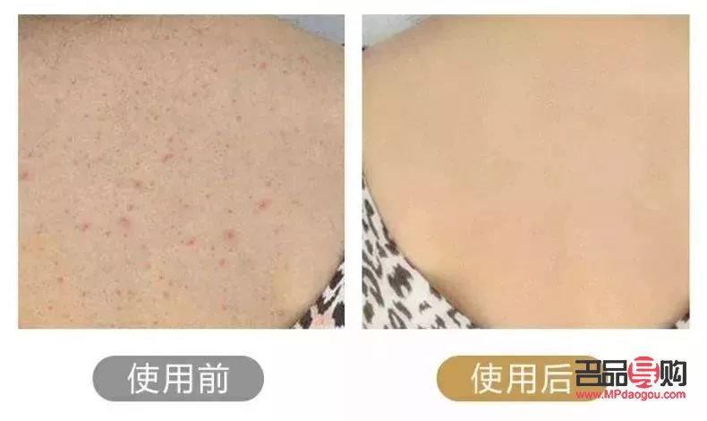 身体去毛后怎么护理呢(身体去毛后怎么护理呢图片)