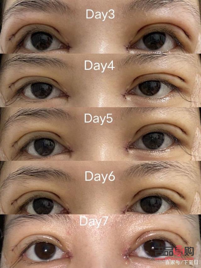 什么双眼皮恢复期最快(什么双眼皮恢复期最快呢)