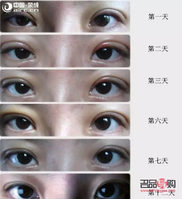 什么双眼皮恢复期最快(什么双眼皮恢复期最快呢)